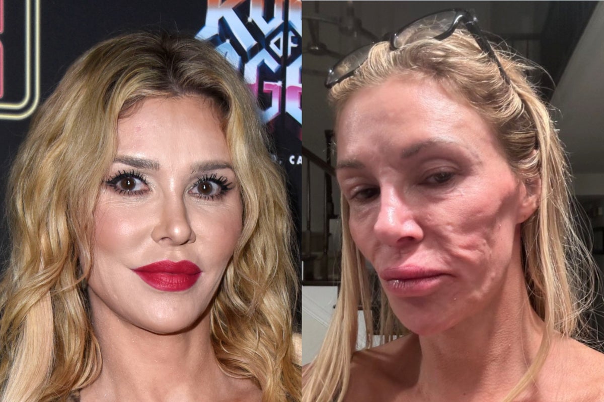 Brandi Glanville bares chilling update on facial lumps as condition spreads to teeth