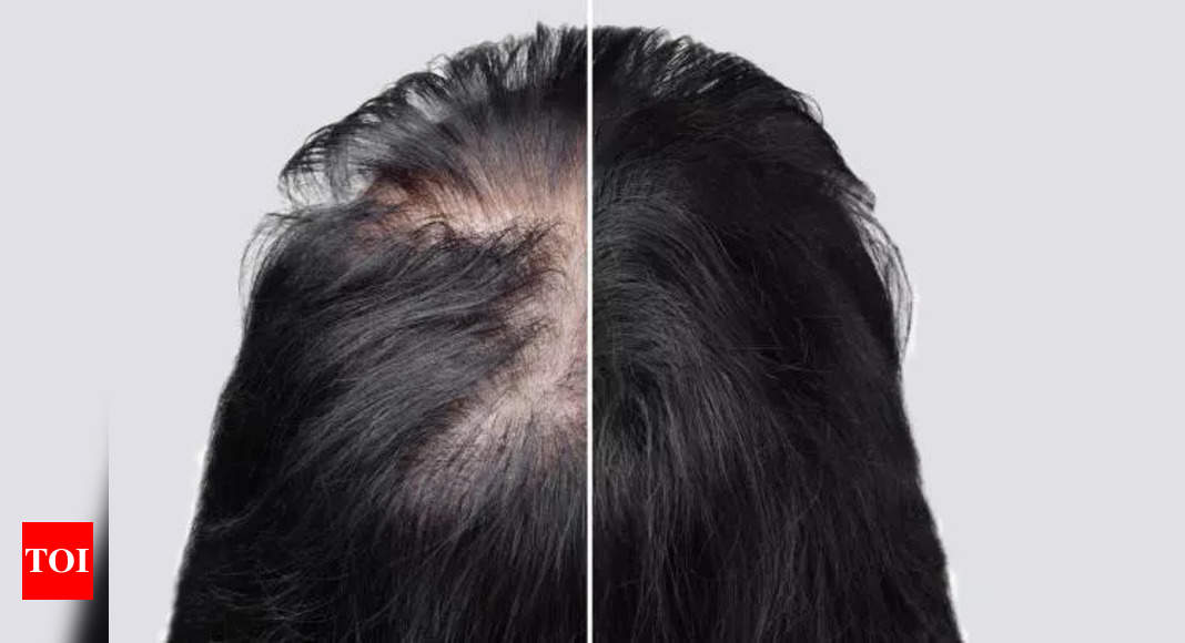 How to use Castor Oil to regrow hair on a bald spot - The Times of India