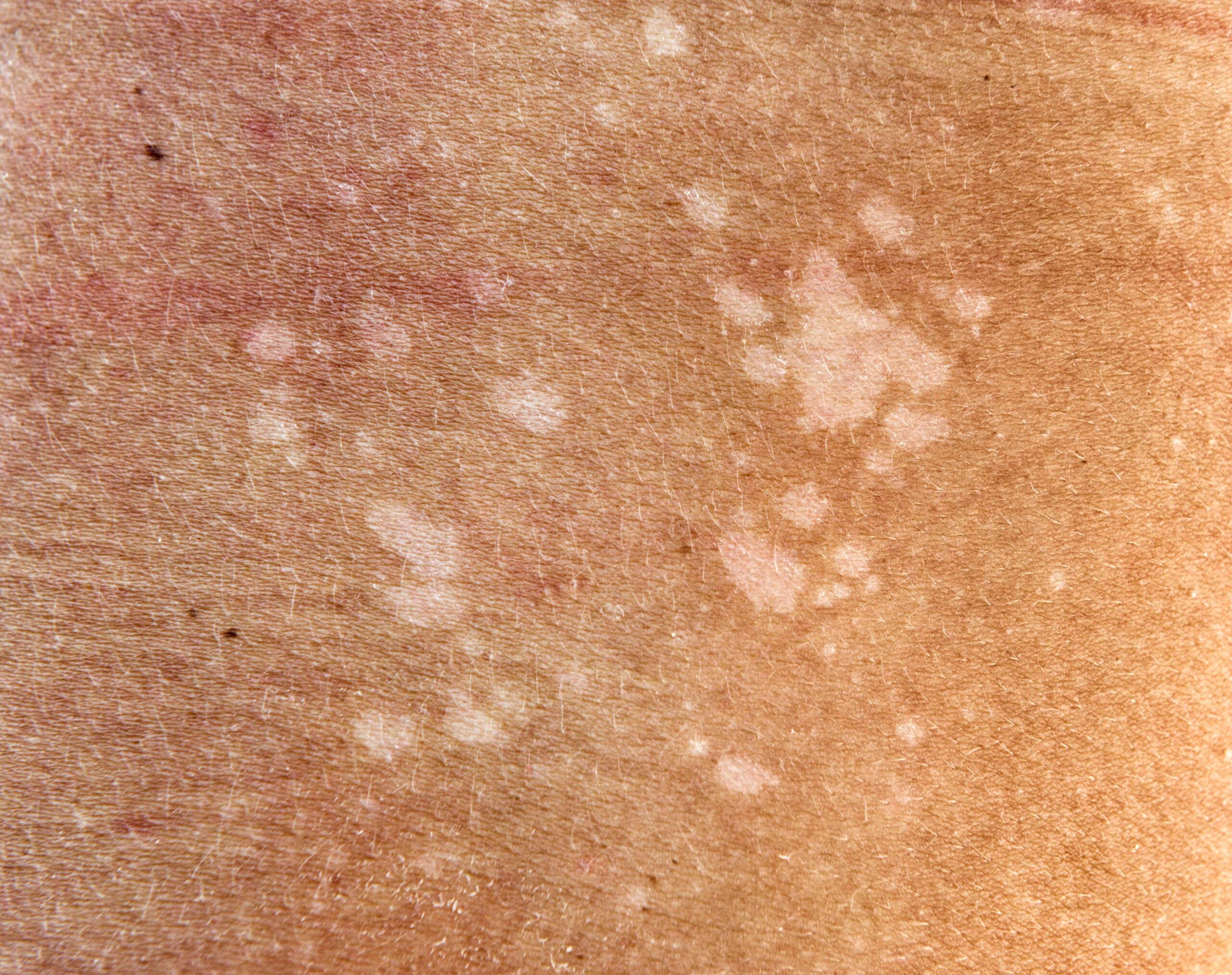 Those Discolored Spots on Your Skin May Be a Fungus: Here's What To Do About It