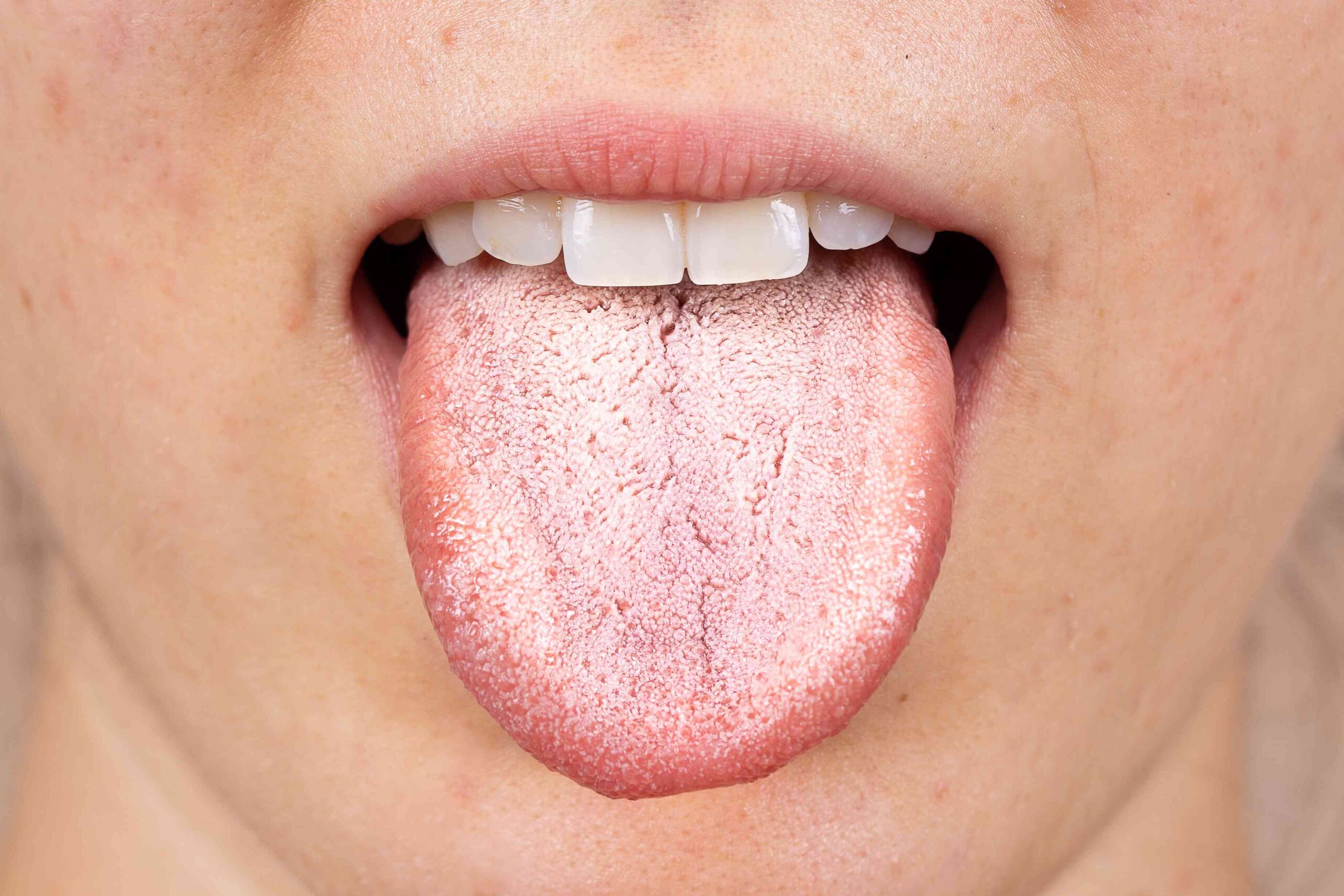 What’s That White Gunk on Your Tongue? What To Know